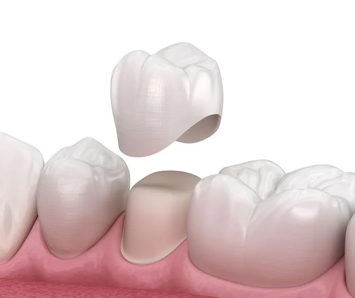 Dental crown restoration