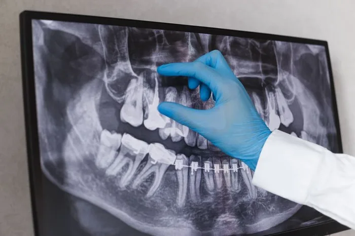 Root canal treatment